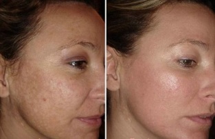 laser-kasvojen ihonhoito ennen valokuvia ja niiden jälkeen